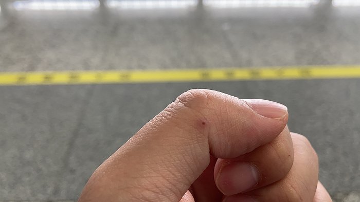 一男子挑开红火蚁蚁巢后被叮咬，一周后仍在发痒，专家称至少一个月后咬痕才会消失。摄影：翟星理